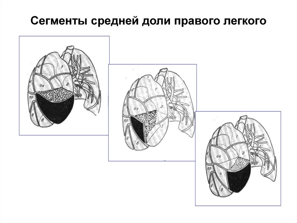 Средний сегмент. Сегменты средней доли правого легкого на кт. Сегменты средней доли правого. Язычковые сегменты легких. Язычковые сегменты левого легкого.