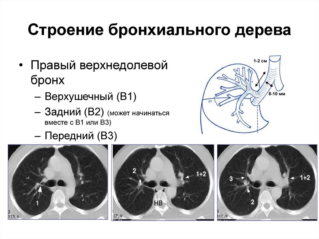 Бронхи схема кт