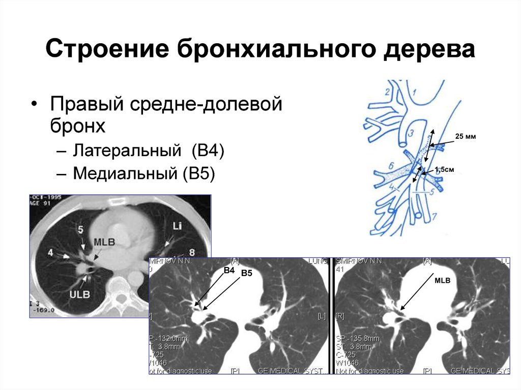 Бронхи на кт схема