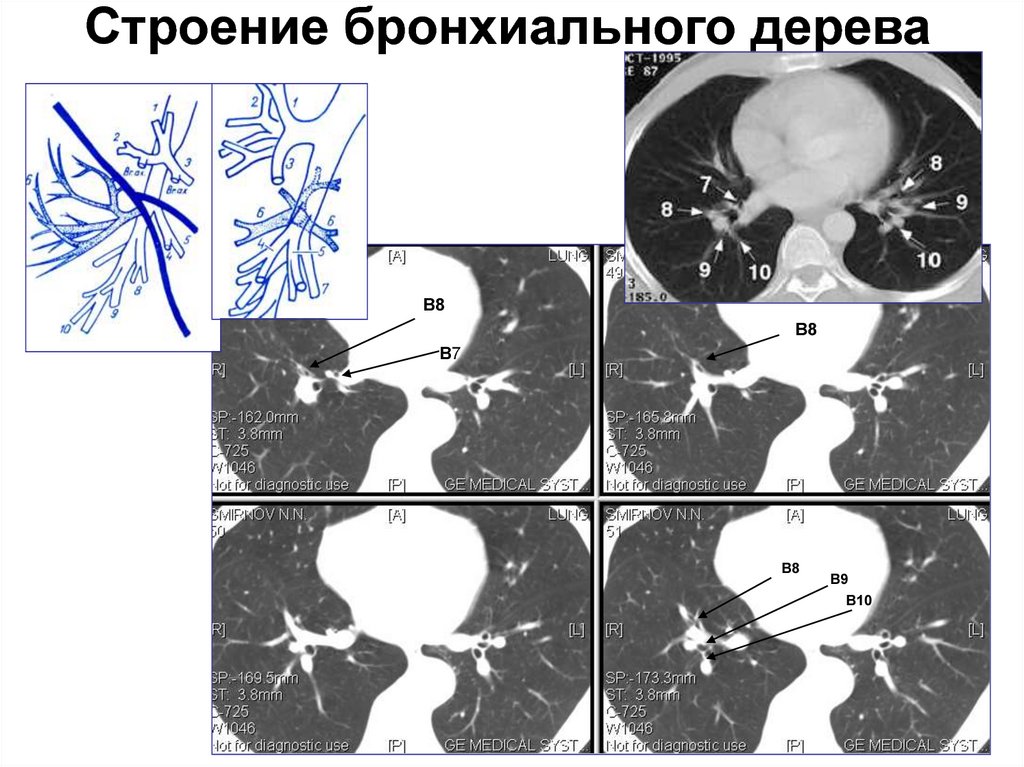 Бронхи на кт схема