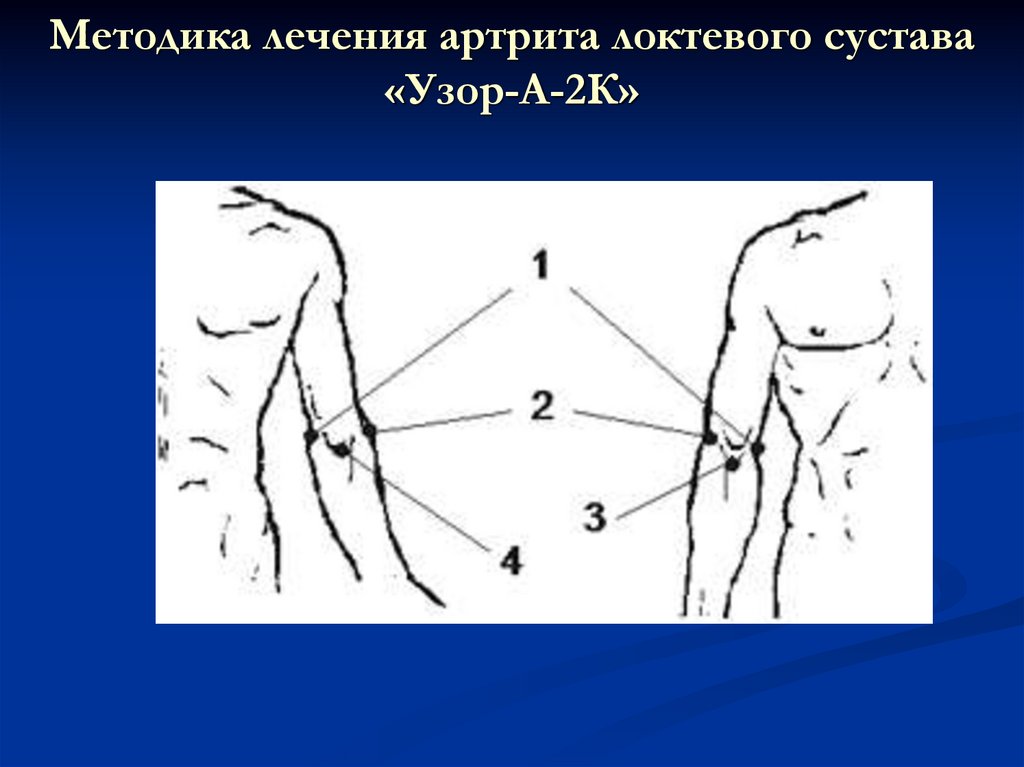 Методика точки. Лазер на локтевой сустав. Лазер на локтевой сустав методика. Точки лазеротерапии локтевой сустав.