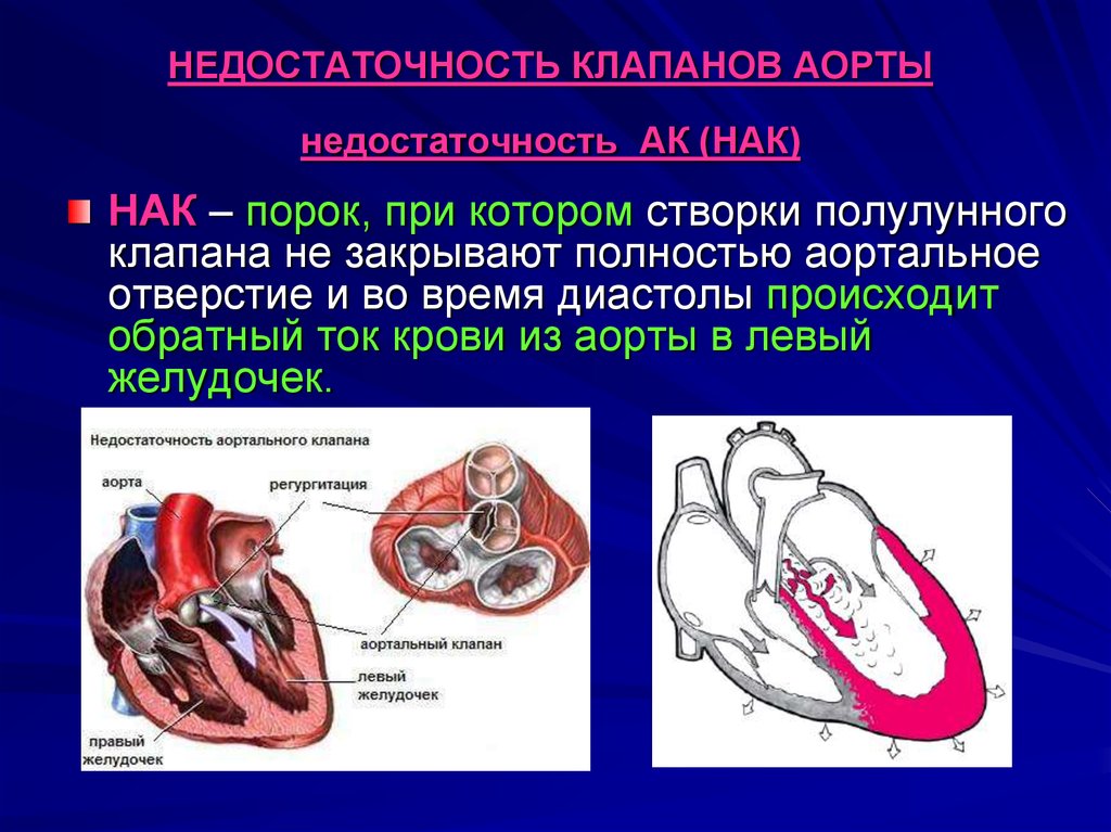 Аортальный стеноз что это такое. Аортальный стеноз и недостаточность. Макропрепарат стеноз аортального клапана. Аортальная недостаточность порок сердца. Пороки сердца аортальный стеноз и недостаточность.