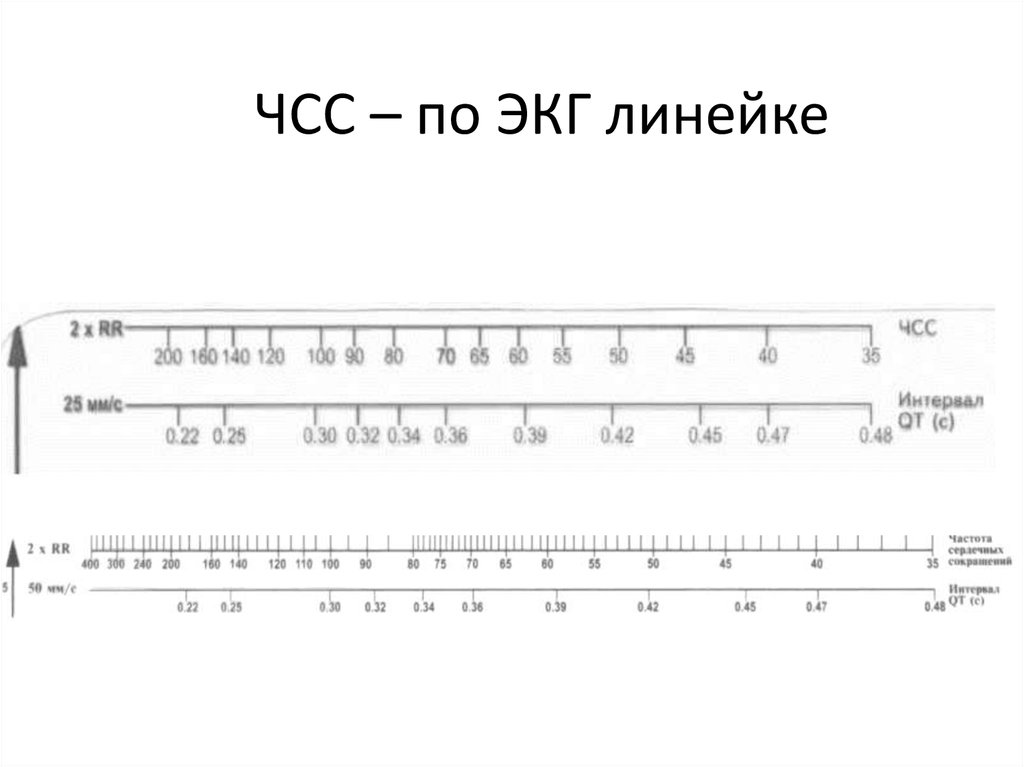 Чсс по экг. Подсчет ЧСС на ЭКГ 25 мм/с. Линейка для измерения ЧСС на ЭКГ. Подсчёт ЧСС по ЭКГ 50 мм. Линейка для расчета показателей ЭКГ.