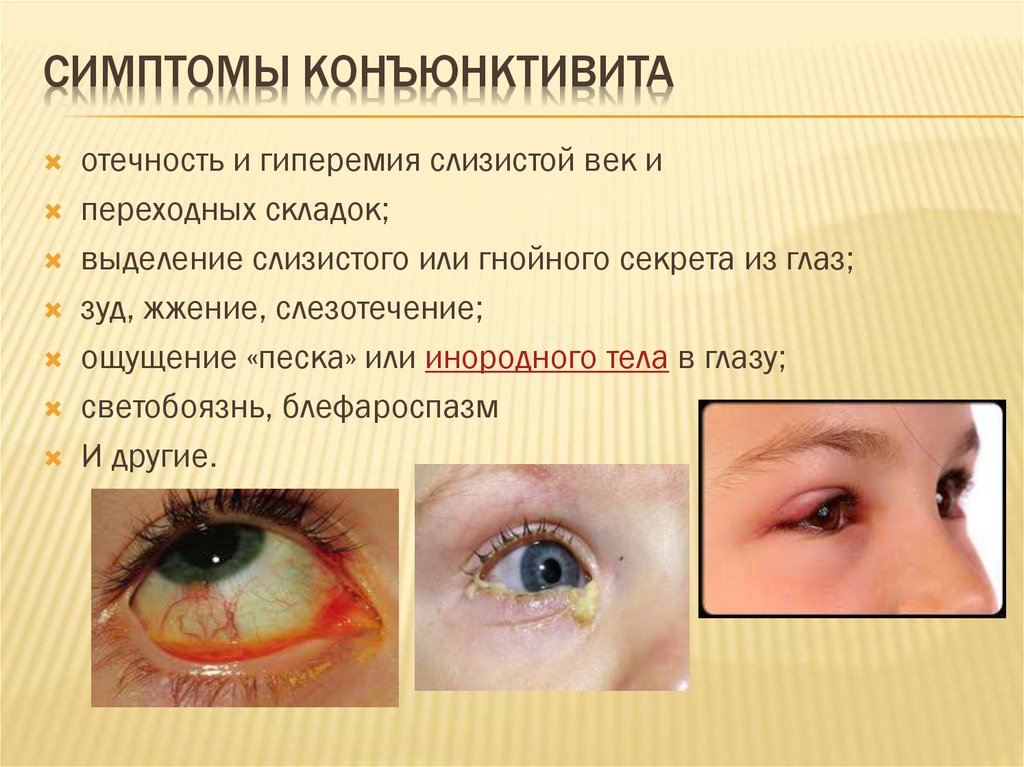 Текут глаза при простуде. Конъюнктивит симптомы вирусный конъюнктивит. Глазное заболевание конъюнктивит симптомы. Конъюнктивит у взрослых симптомы. Вирусный конъюнктивит симптомы.