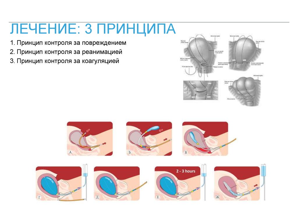 Акушерское кровотечение картинки