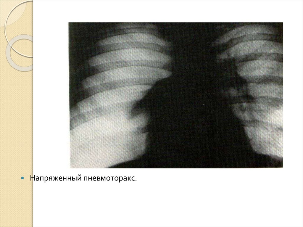 Презентация повреждения грудной клетки