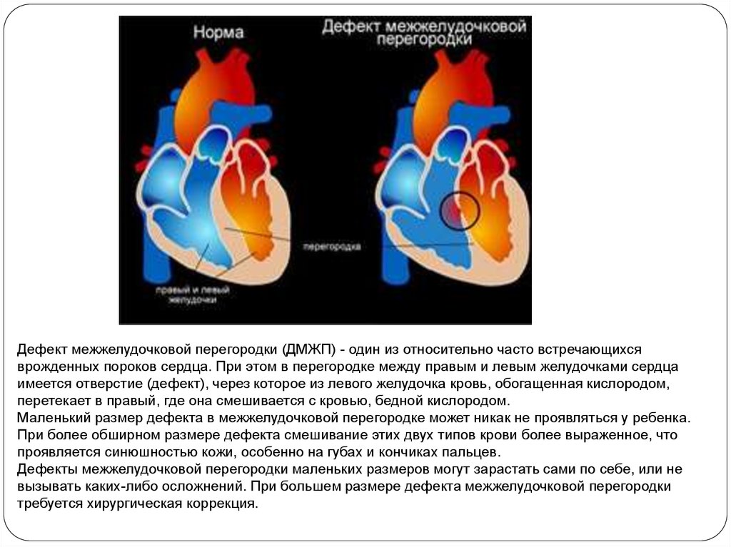 Дефект межжелудочковой перегородки фото