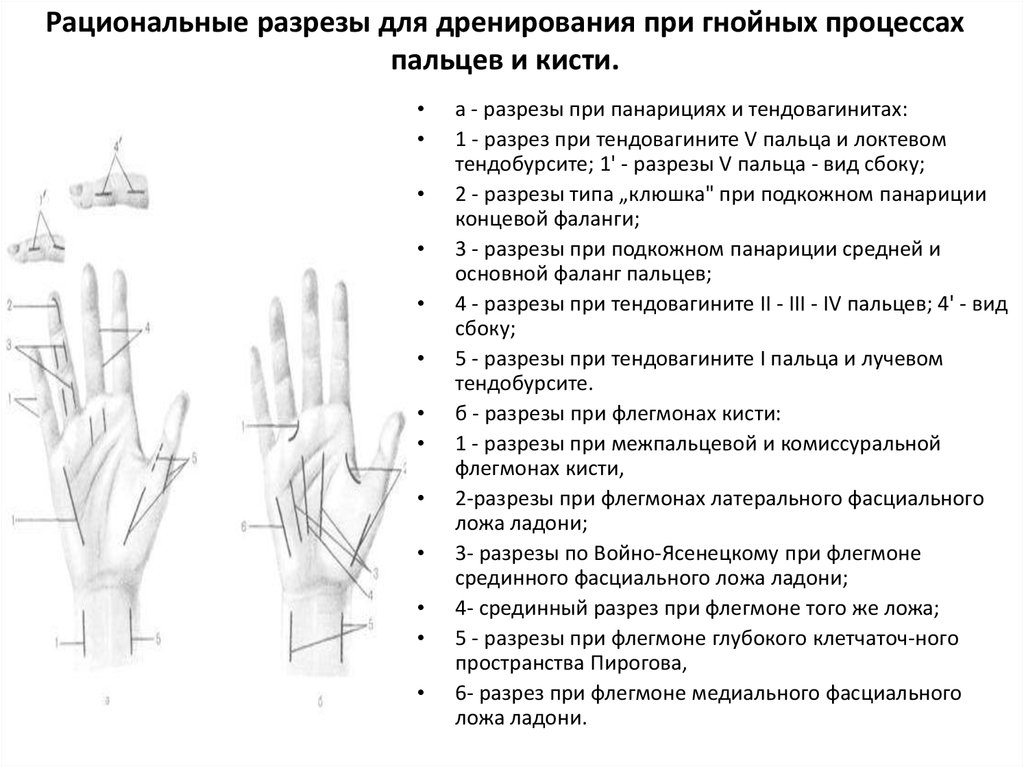 Рациональные разрезы для дренирования при гнойных процессах пальцев и кисти.