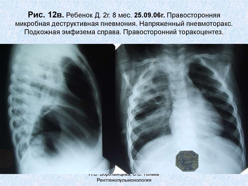 Деструктивная пневмония у детей презентация