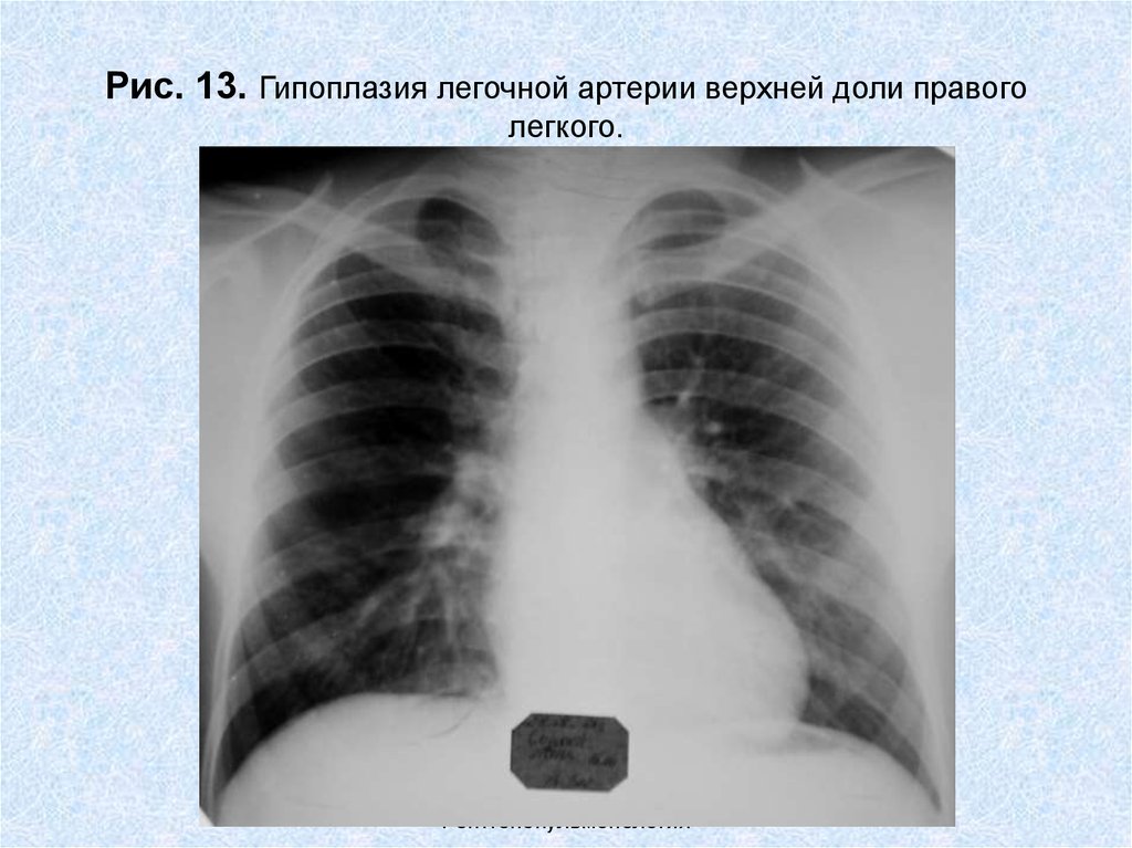 Гипоплазия легкого презентация