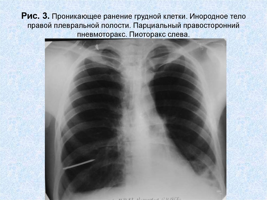Ранение легкого. Рентгенография грудной клетки пневмоторакс. Рентген грудной клетки пневмоторакс. Инородное тело в грудной клетке. Проникающее ранение грудной клетки.