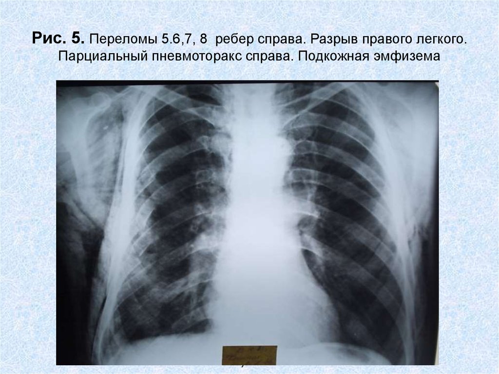 Парциальный разрыв. Перелом ребер 6, 7 рентгенограмма. Перелом ребер пневмоторакс рентгенограмма. Перелом ребер с пневмотораксом рентген. Пневмоторакс справа перелом 6,7 ребер.