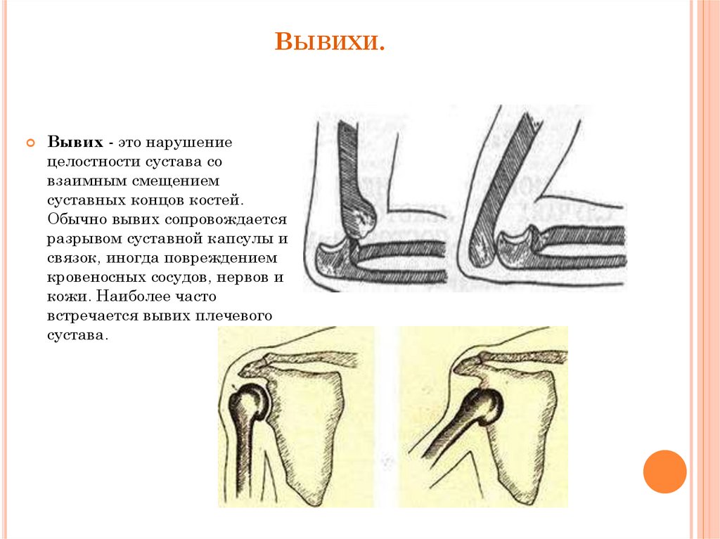 Картинка вывиха сустава