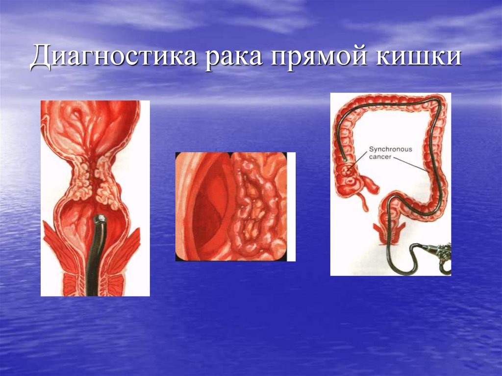 Рак ампулярного отдела. Онкологические заболевания прямой кишки. Выявление опухолей кишечника.