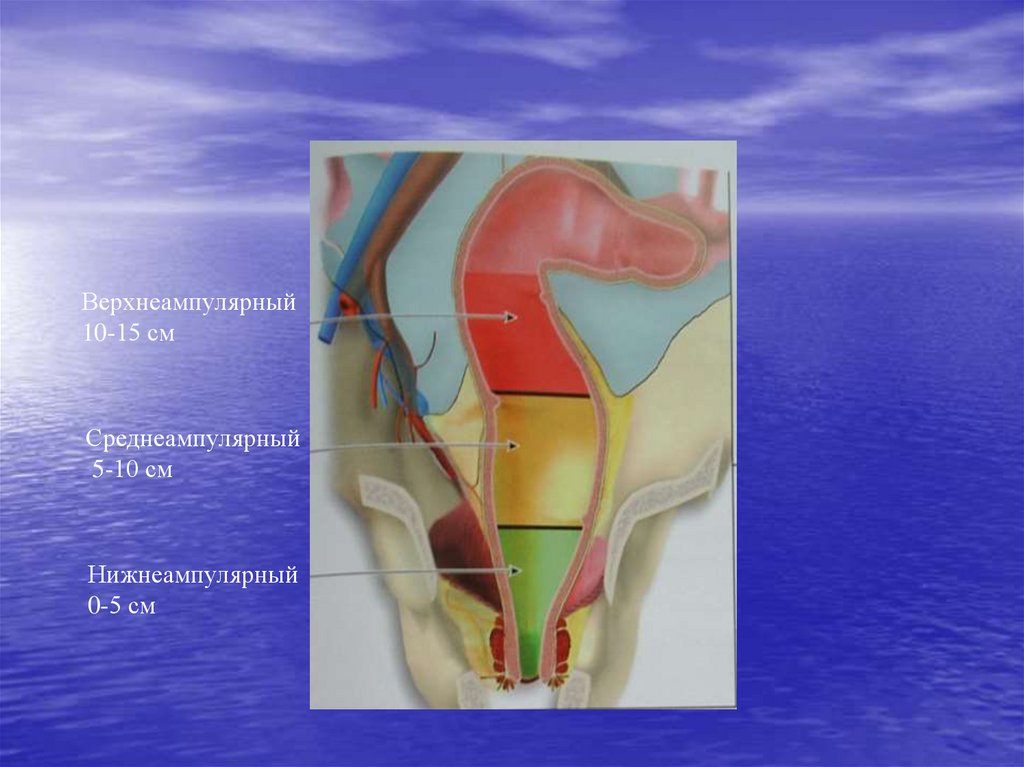 Рак ампулярного отдела. Предампулярный отдел прямой кишки. Ампулярные отделы прямой кишки. Верхнеампулярный отдел прямой кишки. Нижнеампулярный отдел прямой кишки.