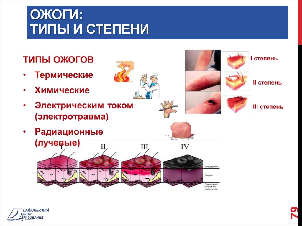 Виды ожогов схема