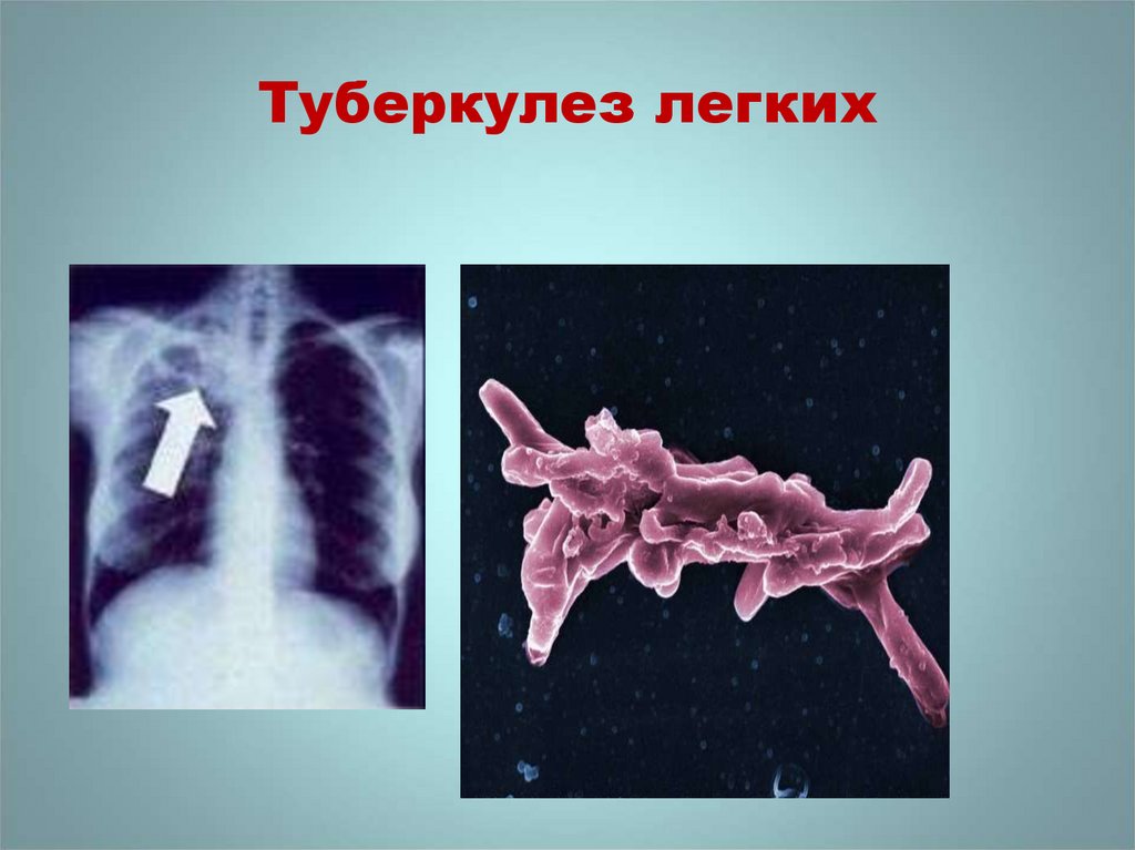 Туберкулез слайд
