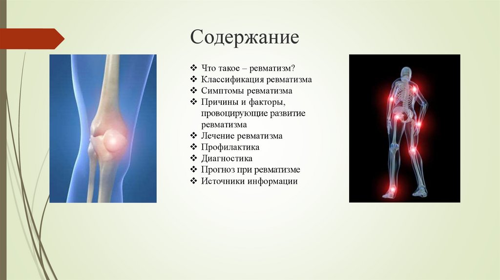 Ревматизм что. Поражение суставов при ревматизме характеризуется.