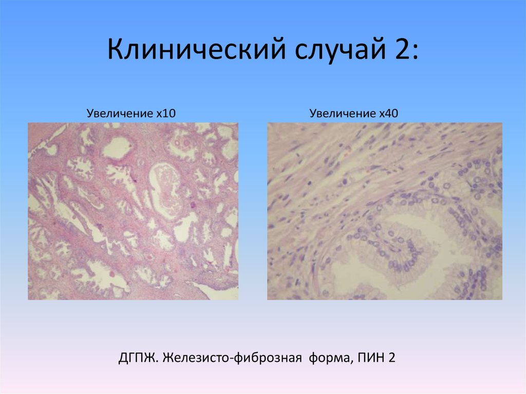Предстательная железа гиперплазия код по мкб. Железистая гипертрофия предстательной железы микропрепарат. Доброкачественная гиперплазия предстательной железы микропрепарат. Железисто фиброзная гиперплазия предстательной железы гистология. Узловая гиперплазия предстательной железы микропрепарат описание.