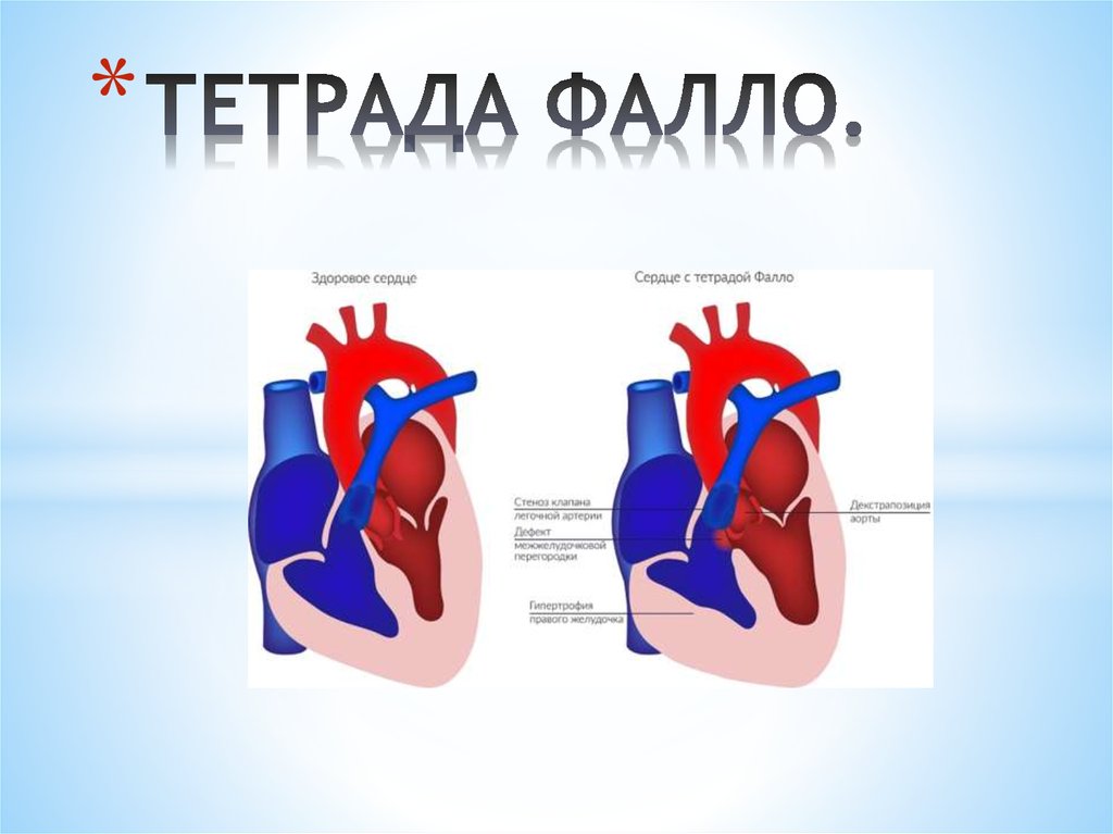 Тетрада фалло у детей