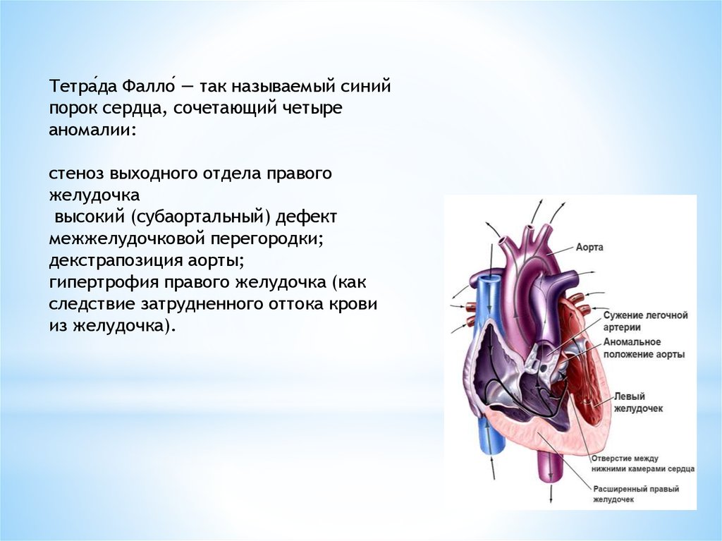 Порок тетрада фалло