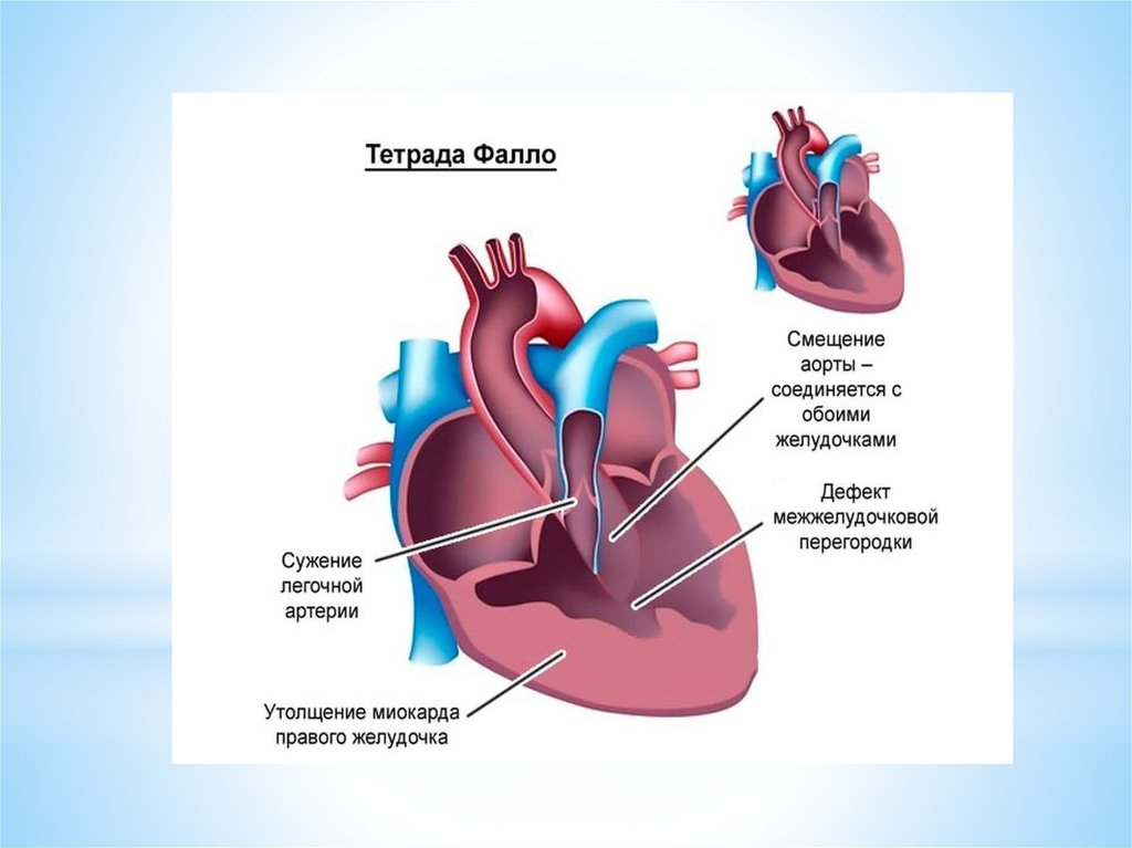 Преимущественное поражение сердца без застойной сердечной. Анатомические признаки тетрады Фалло. Клинические проявления тетрады Фалло.