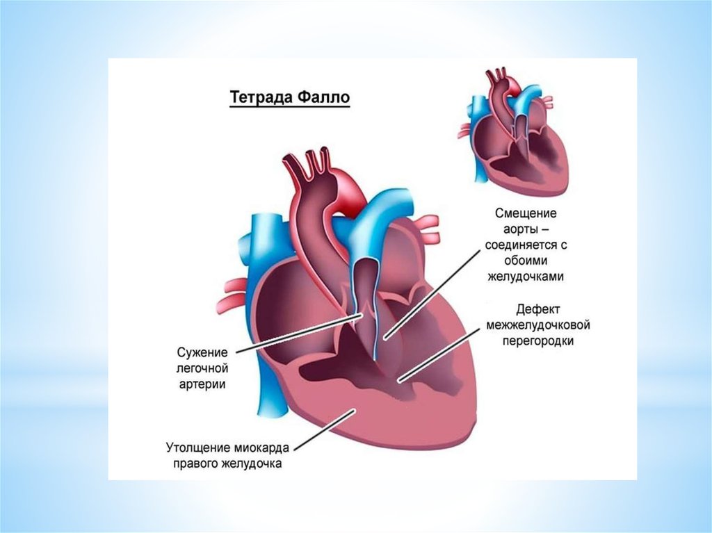 Врожденный порок сердца тетрада фалло презентация