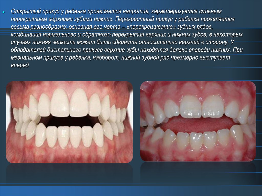 Мезиальная окклюзия презентация ортодонтия