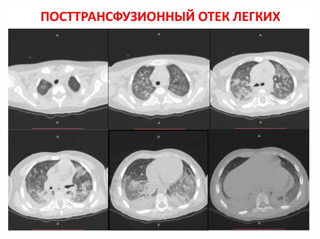 Отек легких на кт картинки