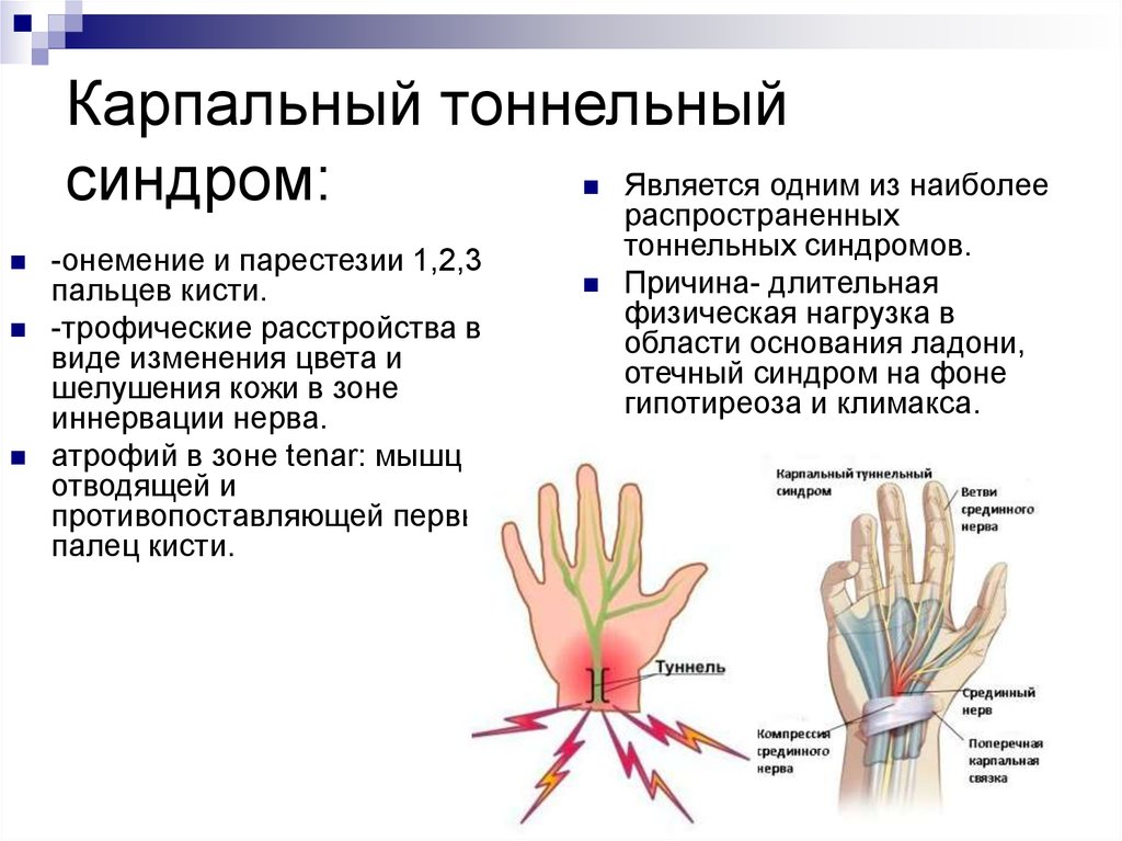 Картинки туннельный синдром