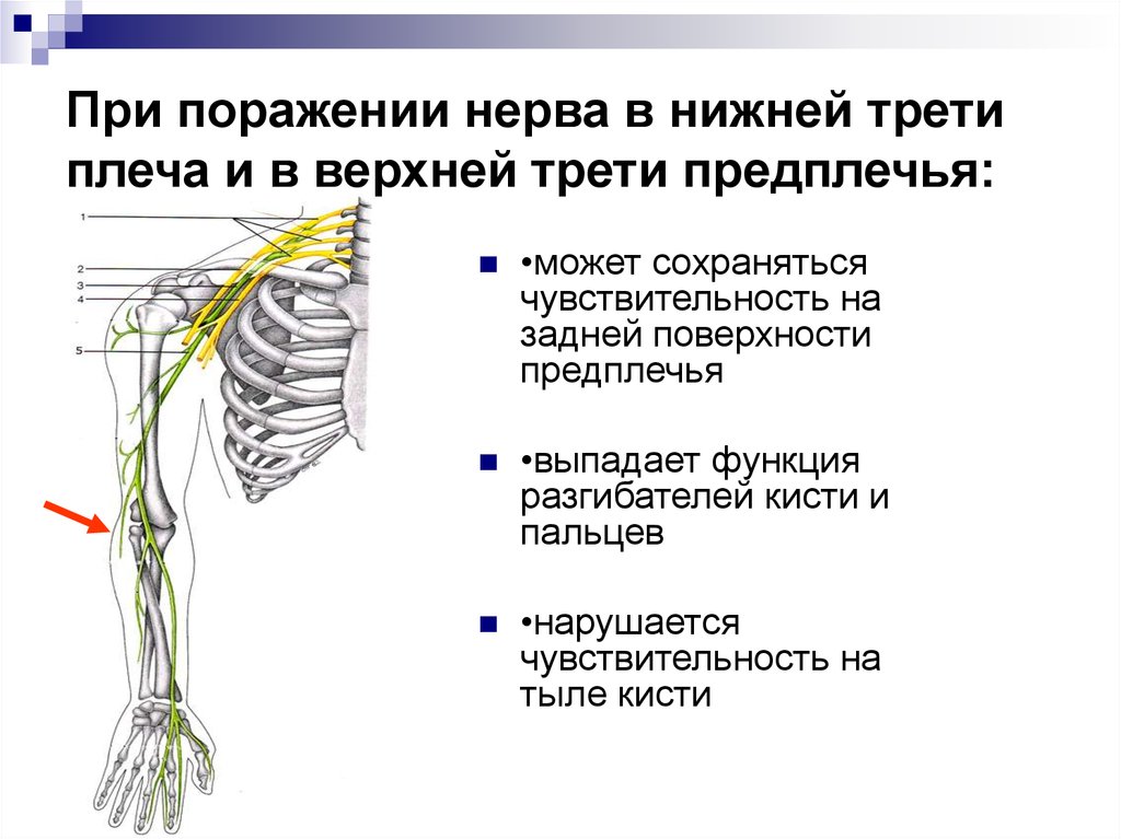 Моторная невропатия малоберцового нерва