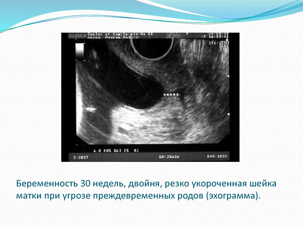 Удлиненная матка при беременности. Укороченная шейка матки при беременности. Измерение шейки матки при беременности на УЗИ. Укороченная шейка матки при беременности 30 недель.