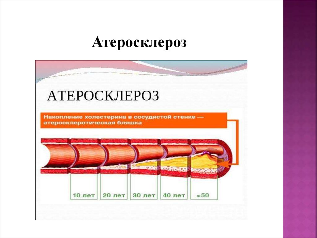 Атеросклероз картинки для презентации