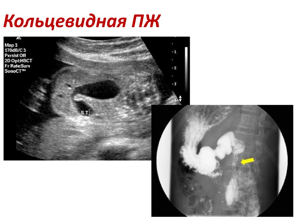 Аберрантная поджелудочная железа. Кольцевидная поджелудочная железа УЗИ. Аберрантная поджелудочная железа УЗИ. Кольцевидная поджелудочная железа рентген. Кольцевидная форма поджелудочной железы.