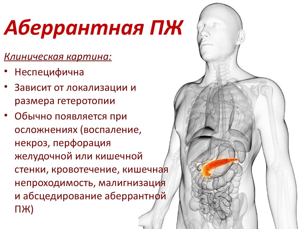 Щитовидная железа поджелудочная железа. Аберрантная поджелудочная железа. Аберрантная доля поджелудочной железы что такое. Аномалии поджелудочной железы. Аберрантная щитовидная железа.