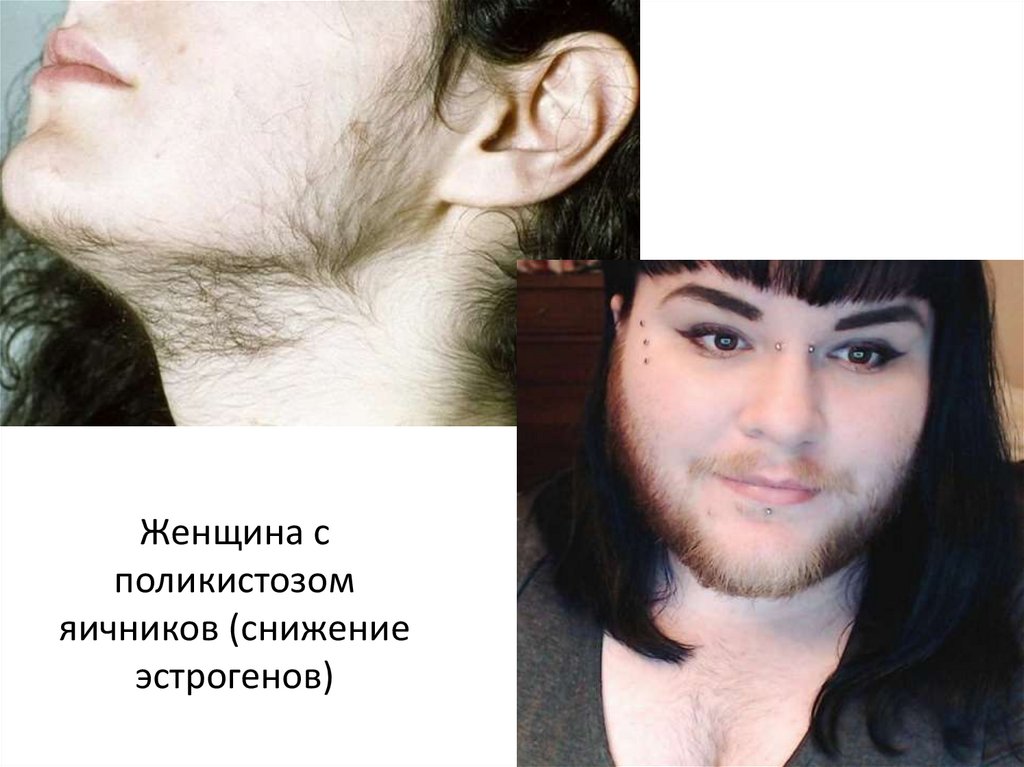 Женщина с поликистозом яичников (снижение эстрогенов)