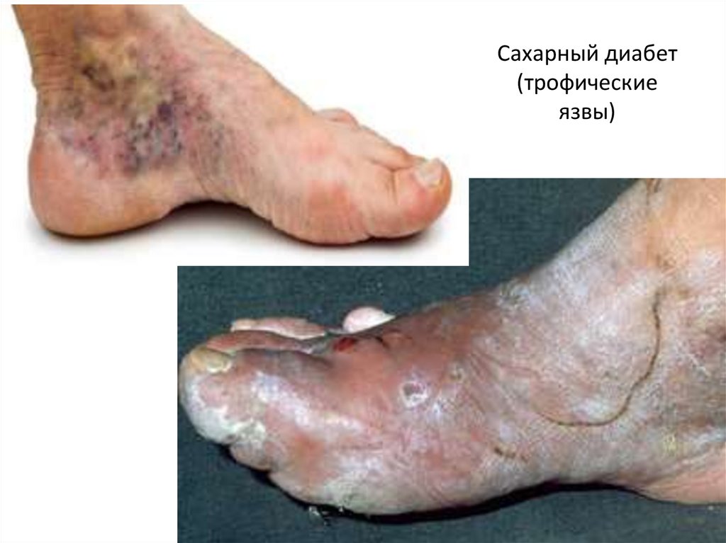 Сахарный диабет (трофические язвы)