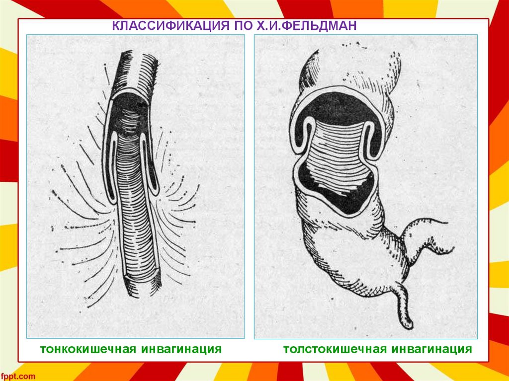 Инвагинация кишечника у детей. Инвагинация классификация. Инвагинация кишечника у детей классификация. Инвагинация кишечника классификация. Тонкокишечный инвагинат.