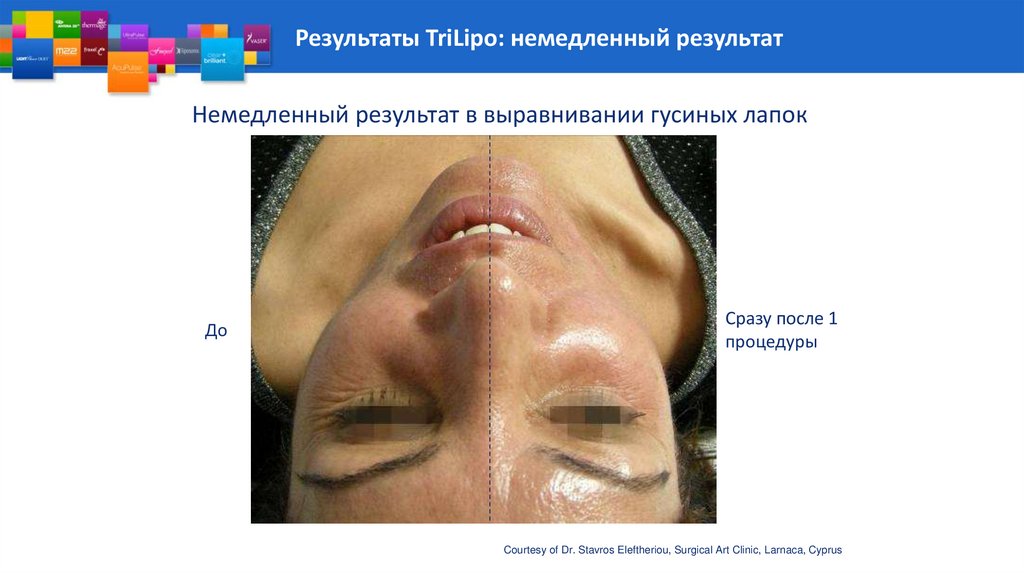 Результаты TriLipo: немедленный результат