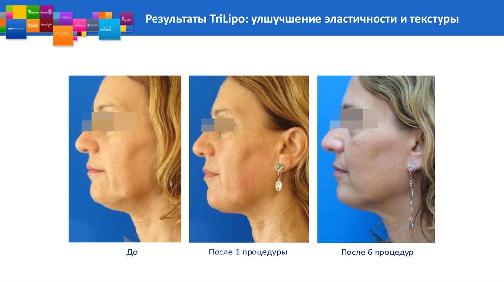 Результаты TriLipo: улшучшение эластичности и текстуры