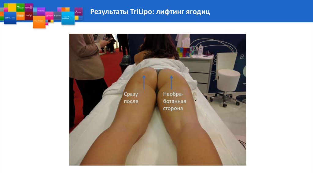 Результаты TriLipo: лифтинг ягодиц