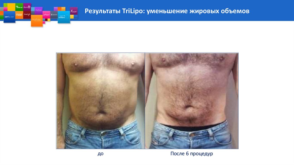 Результаты TriLipo: уменьшение жировых объемов