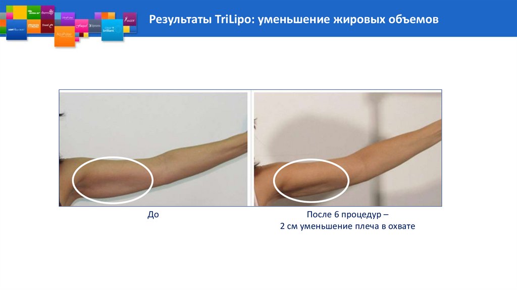 Результаты TriLipo: уменьшение жировых объемов