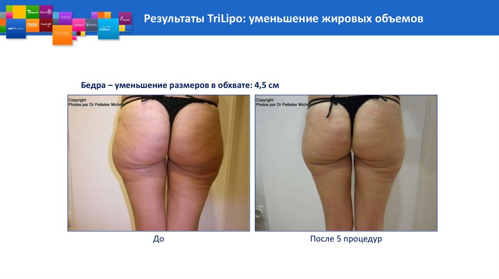 Результаты TriLipo: уменьшение жировых объемов