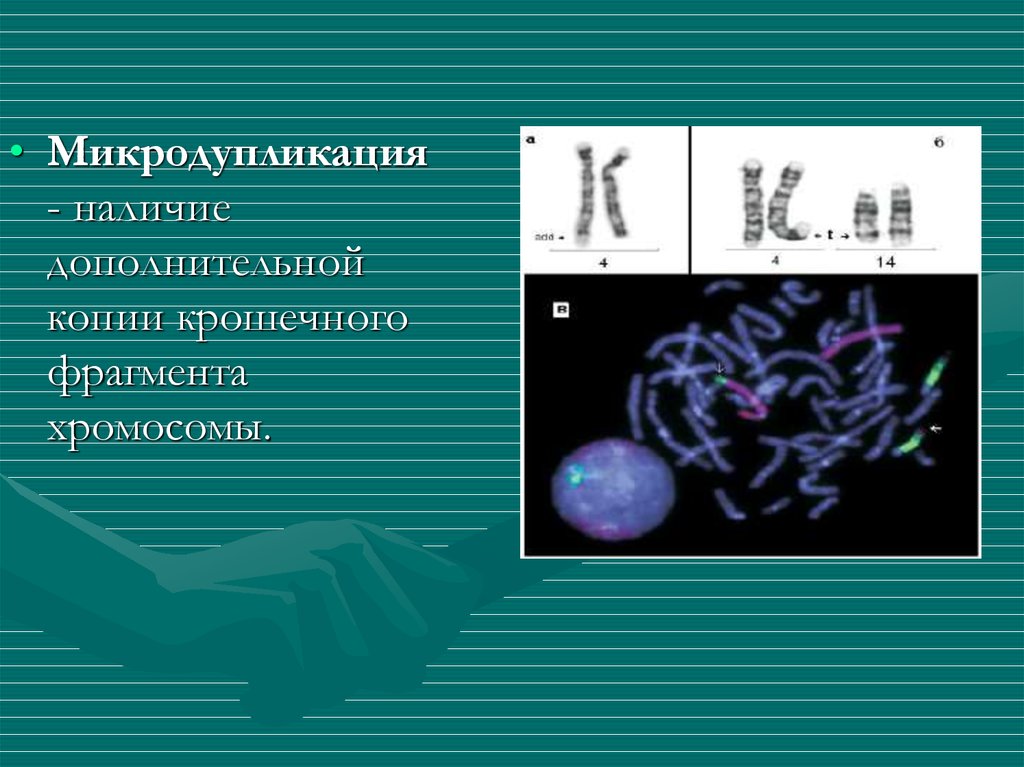 Аномалия хромосом. Микродупликация хромосомы это. Микроструктурными аномалиями хромосом. Синдром хромосомной микроструктурной патологии. Фрагмент хромосомы.