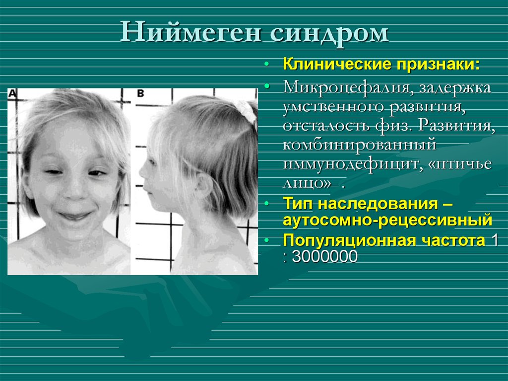 Синдром развития. Микроцефалия синдром Ниймеген. Синдром Ниймеген иммунология. Синдром Ниймеген фото.