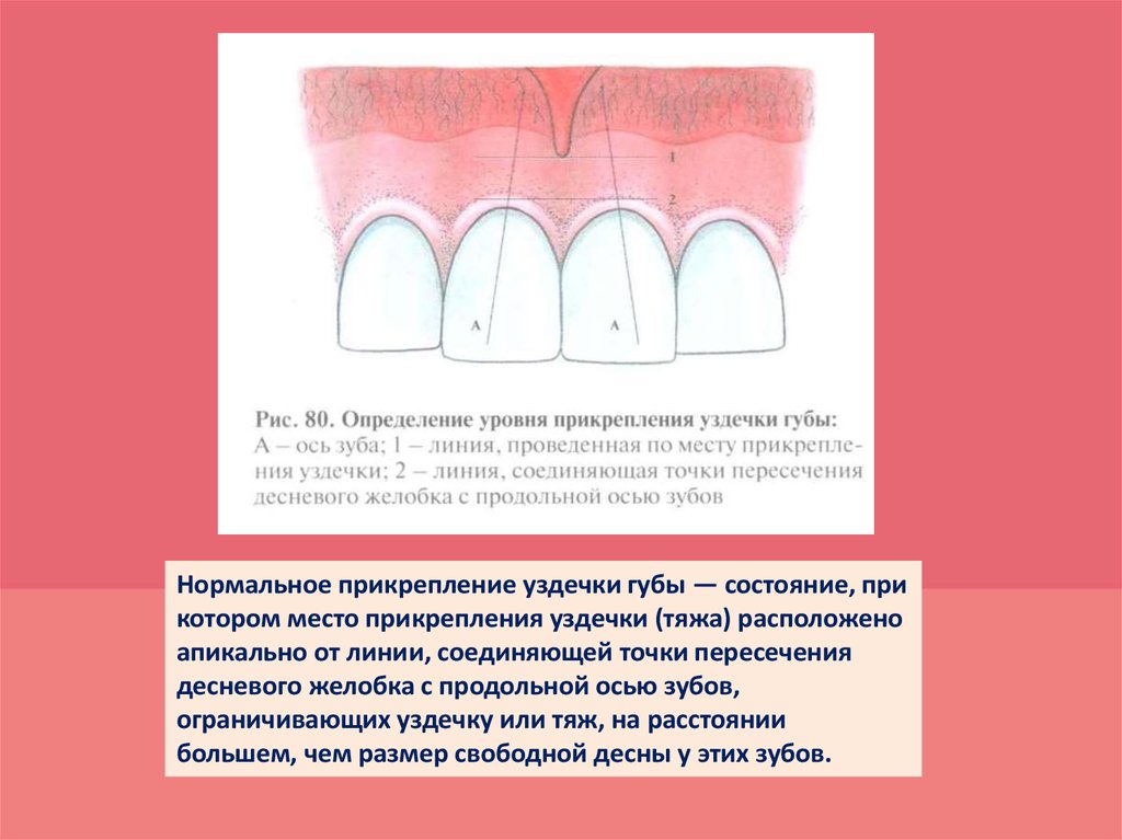 Состояние тканей пародонта. Определение уровня прикрепления уздечки губы. Низкое прикрепление уздечки верхней губы. Низкое прикрепление уздечки верхней губы у детей. Переходная складка зуба.