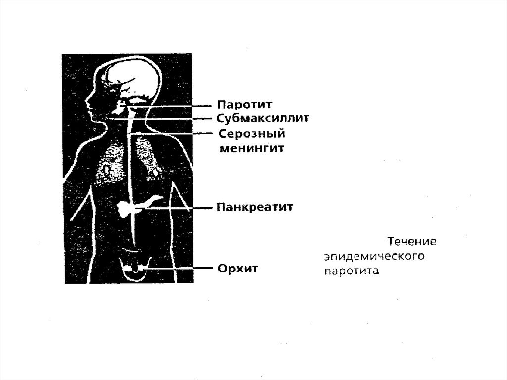 Течение паротита. Эпидемический паротит орхит. Эпидемический паротит рисунок. Эпидемический паротит менингит.