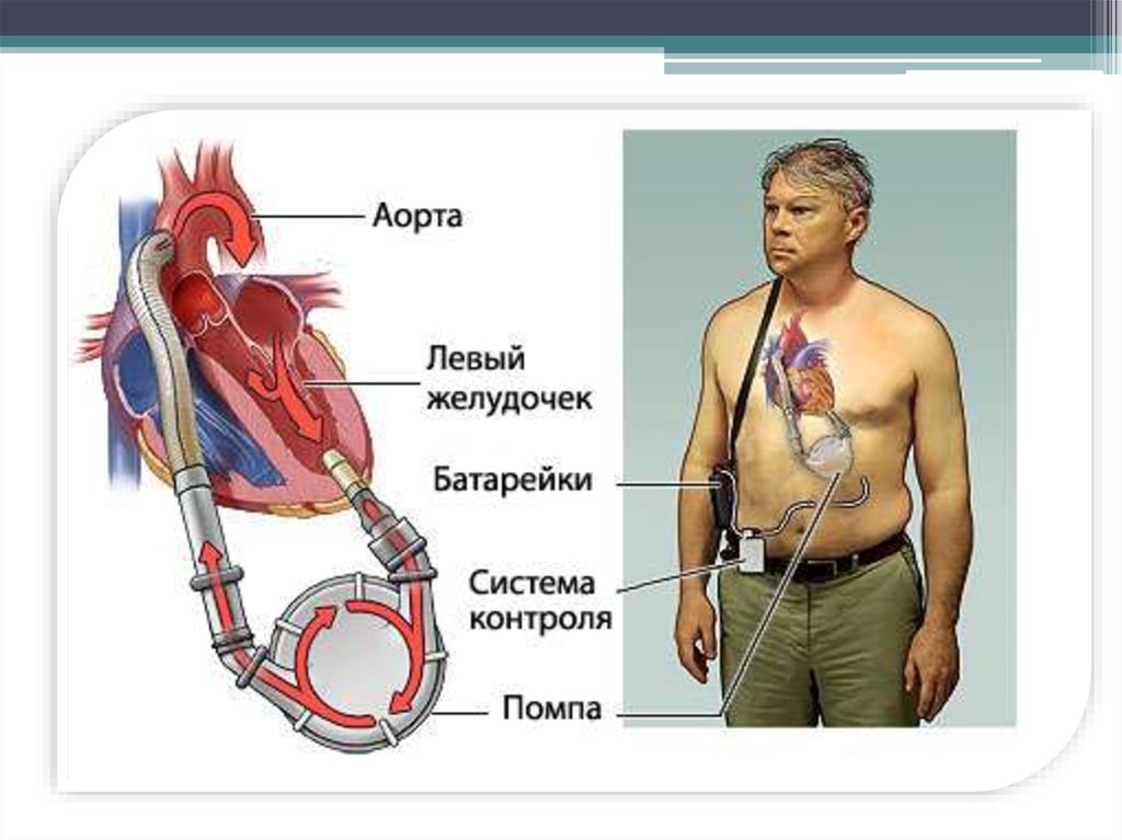 Сколько весит искусственный левый желудочек для сердца. Механический левый желудочек сердца. Искусственный левый желудочек. Искусственный левый желудочек сердца. Механические желудочки сердца.