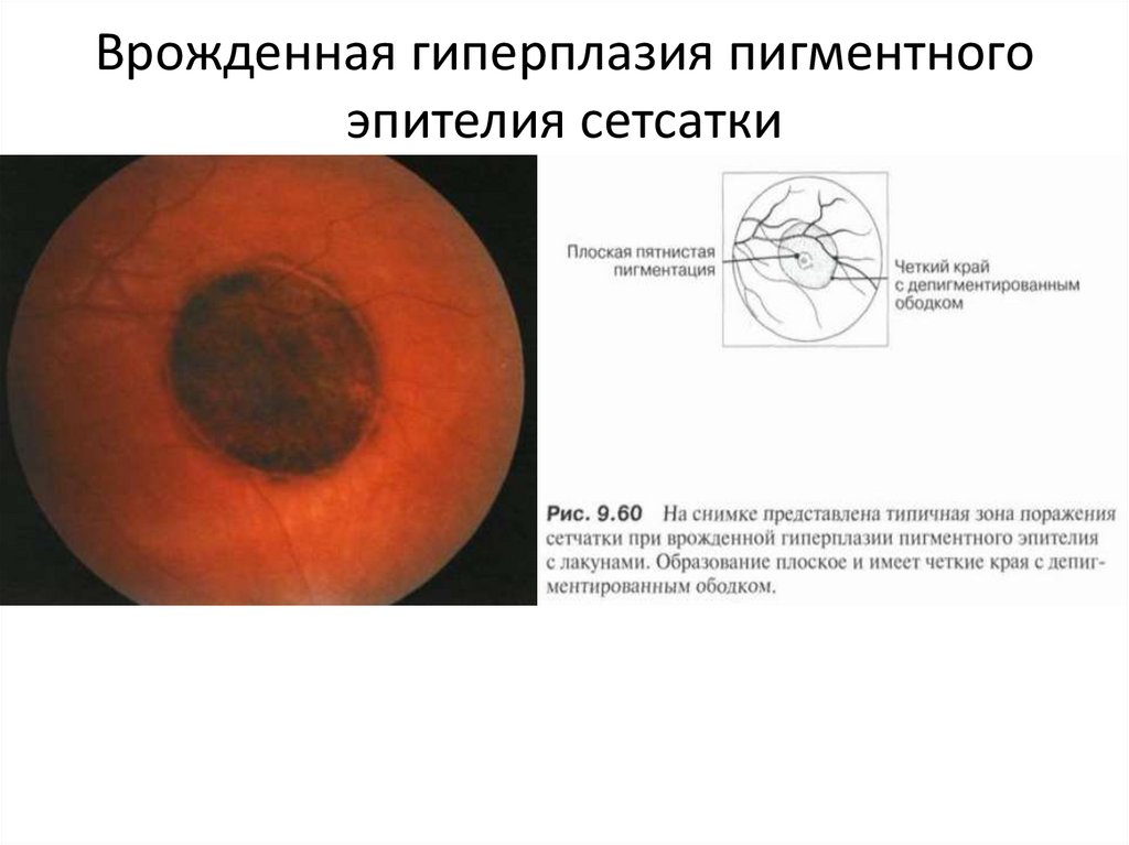 На рисунке пигментного эпителия сетчатки изображены гранулы меланина